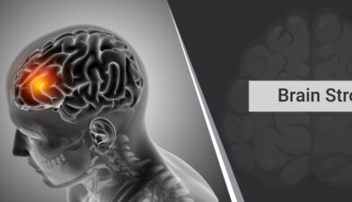 Understanding Stroke Early Warning Signs and Prevention Tips