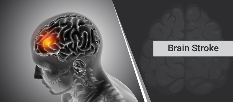 Understanding Stroke Early Warning Signs and Prevention Tips